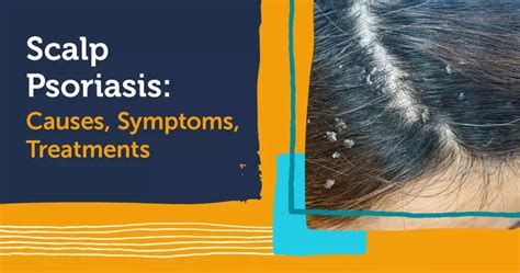 Scalp Psoriasis Causes Symptoms And Treatments Mypsoriasisteam