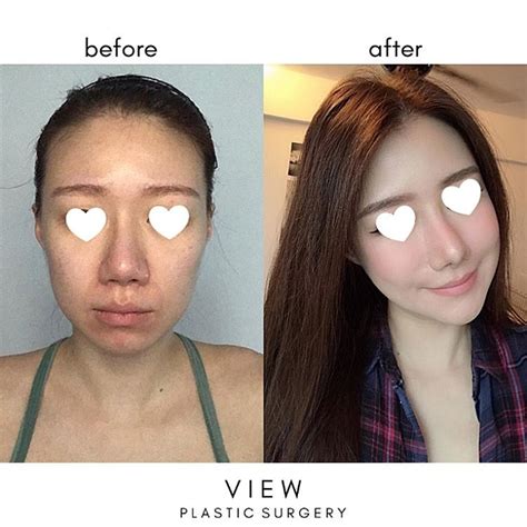 Face Off View Plastic Surgerys Face Contouring Surgery Can Make Your