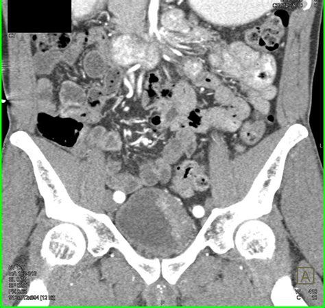 Infiltrating Bladder Cancer In Left Wall Of Bladder Genitourinary