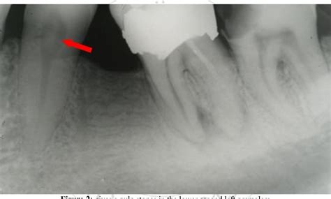 Figure 2 From A Radiographic Assessment Of The Prevalence Of Pulp