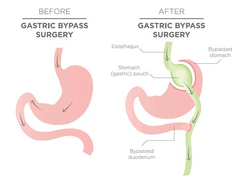 Gastric Bypass Surgery Cost The Surgical Weight Loss Centre