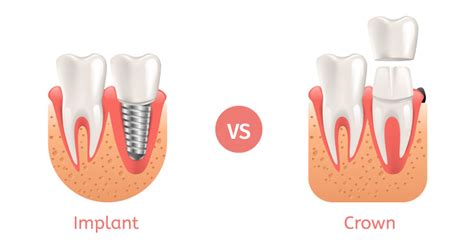Alan Robinson Dds Pc Dentist In Clinton Township Crown Versus Implant