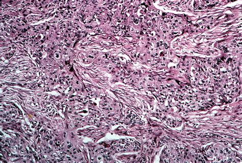 ZdjĘcia Squamous Cell Carcinoma Lesion Histology Jak WyglĄda JĄ