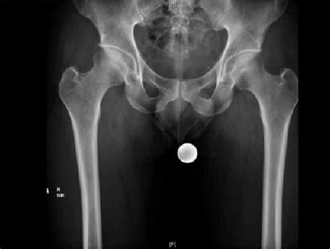 Anteroposterior Pelvic Radiograph 8 Months After Injury The Image