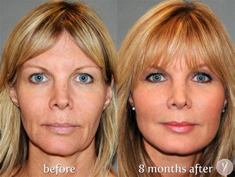 the y lift face lift procedure phoenix skin y lift before and after y lift phxskin 4 face