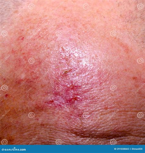 Scar After Surgery To Remove Skin Cancer On The Head Stock Image