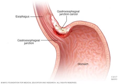 Tumors can be cancerous (malignant) or noncancerous (benign). Stomach cancer Disease Reference Guide - Drugs.com