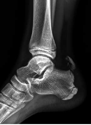 Preoperative lateral radiograph shows the avulsion ...
