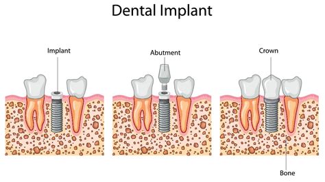 A Comprehensive Guide To The Dental Implant Process Step By Step