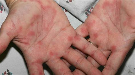 Erythema Multiforme Symptoms Pictures Causes Treatment