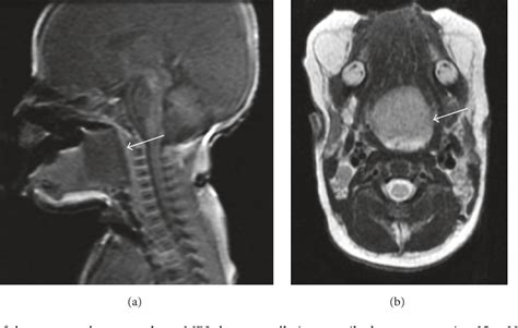 Figure 1 From A Neonatal Case Of Glial Choristoma Of The Tongue Causing