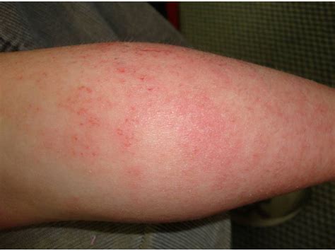 Consultations In Dermatology The Rash That Itches Atopic Dermatitis