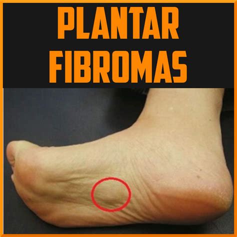 Overview Of Plantar Fibromas Sports Activities Medication Overview