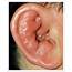 External Ear Disease  Ento Key