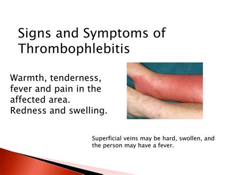 Ppt Thrombophlebitis Powerpoint Presentation Free Download Id2246423