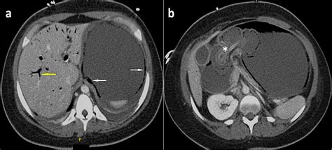Cureus Anterograde Gastroduodenal Intussusception A Rare But Lethal