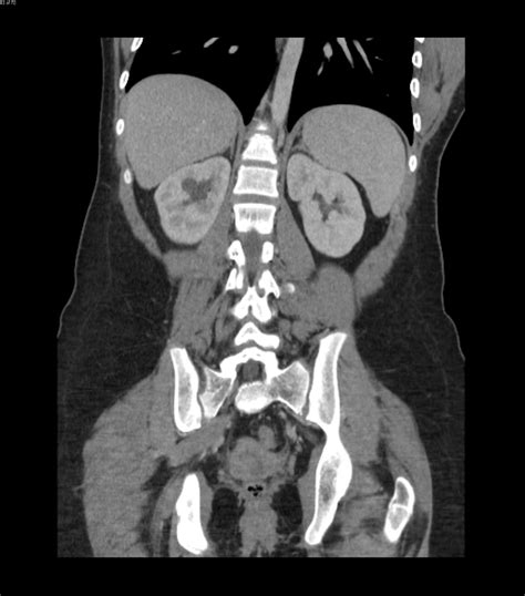 Unknown Case 5 Intravenous Pyelogram And Abdominal Ct