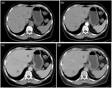 A Four Phase Ct Scan Through The Liver A Pre Contrast Axial Image