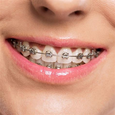 Types Of Braces Drake Orthodontics