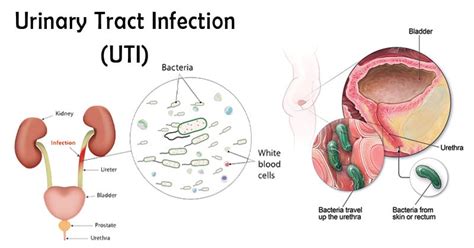 Types Of Urinary Tract Infections Symptoms Causes Treatment Sutured