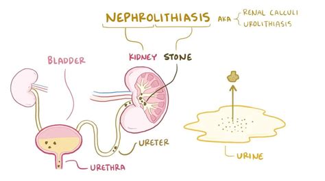 What Is The Pathophysiology Of Kidney Stones