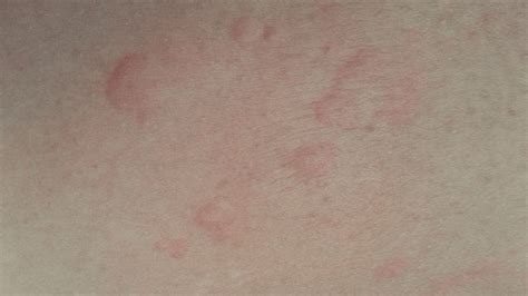 Red Bumpy Rash On Legs Pictures Photos