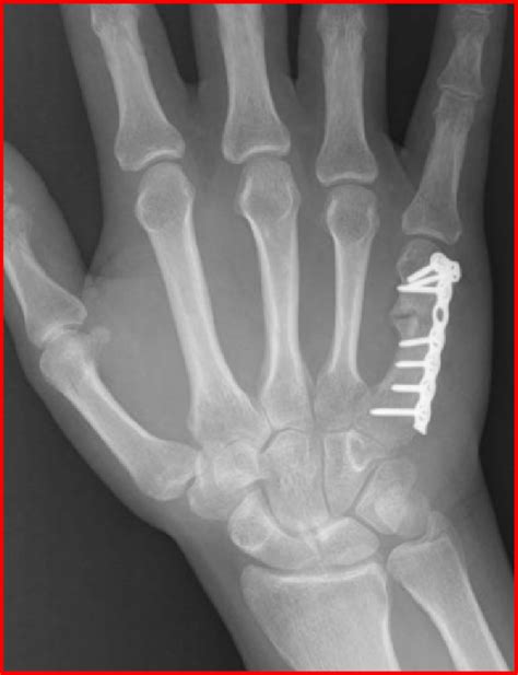 Plate And Screw Fixation Of An Angulated Fifth Metacarpal Neck Fracture