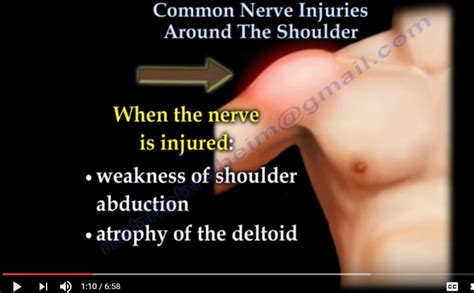 Shoulder Nerve Injury Dnb Orthopaedics Ms Orthopedics Mrcs Exam Guide