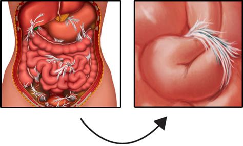 A complete obstruction is a medical emergency and may require surgery. What is a bowel obstruction THAIPOLICEPLUS.COM