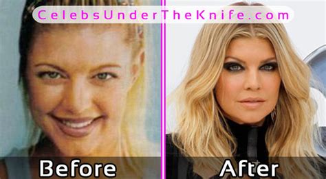 3 Best Plastic Surgery Before And After Photos