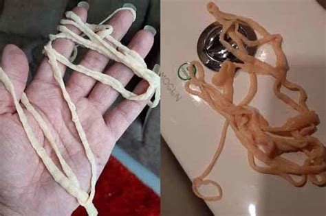 Man Left Horrified After He Pulls Out 32 Feet Tapeworm From His Body In The Restroom
