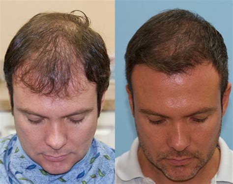 FUE Hair Transplant Case Study 2 Day 3500 Grafts Carolina Hair
