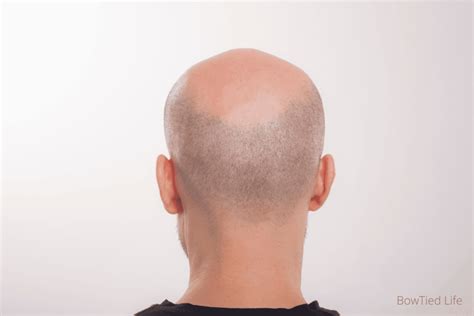 Balding Around The Crown What It Looks Like And How To Stop It