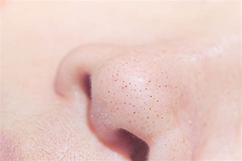 Close Up Macro Of Many Acne Small Blackhead Pimples On The Nose Stock