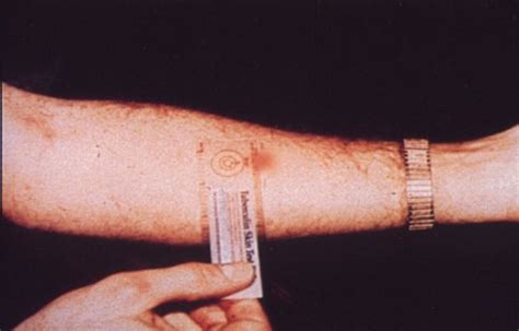 Hi, friends, we know in this video what is ppd or mantoux test. PPD Tuberculin Skin Testing