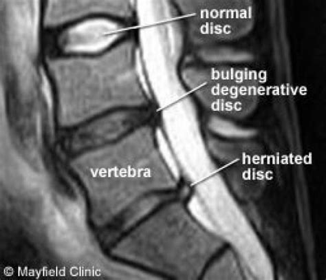 Sagittal Mri Of Herniated L S Lumbar Disc Lowerbackpain Bulging Disc Mri Herniated