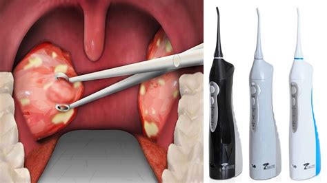 What Are Tonsil Stones What Causes Mucus Balls In Back Of Throat