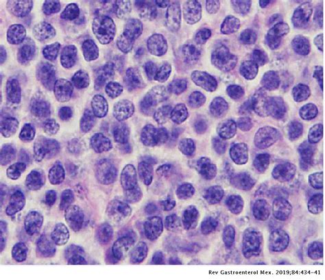 Mantle Cell Lymphoma With Involvement Of The Digestive Tract Revista