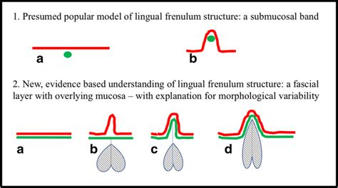 Anatomically Based Understanding Of The Lingual Frenulum According To Download Scientific