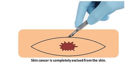 Surgical Treatment Of Skin Cancer Pennsylvania Dermatology Specialists