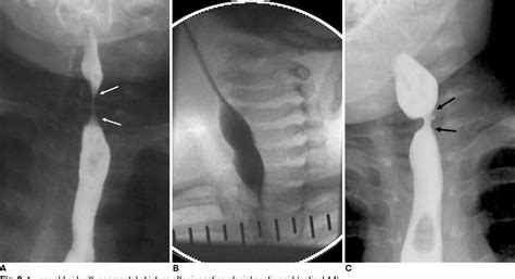 Figure 3 From Balloon Dilatation For Corrosive Esophageal Strictures In
