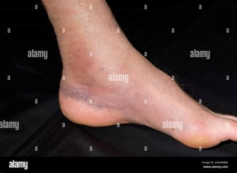 Model Released Bruised Ankle Haematoma Bruise On The Ankle Of A 56