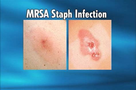Mrsa Staph Infection Symptoms Causes And Prevention Los Angeles