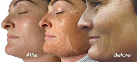 Chemical Peel Dover Oh And Canton Oh Ohio Laser And Wellness Centers