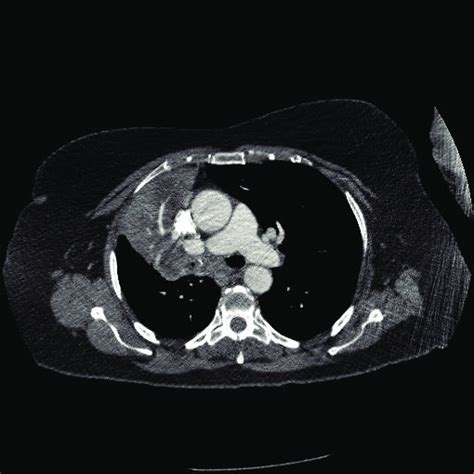 Pet Scan Image Showing Fdg Avid Large Right Upper Lobe Heterogeneous