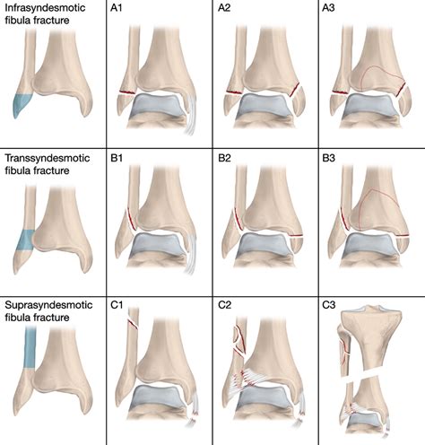 The Ao Ota Classification Of Ankle Fractures Illustration By Pontus Download Scientific