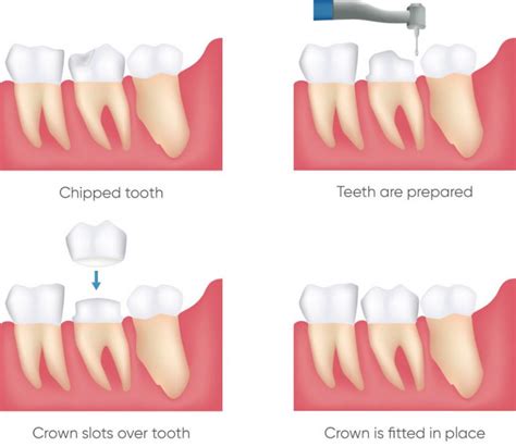 Dental Crowns Neutral Bay Elite Dentistry