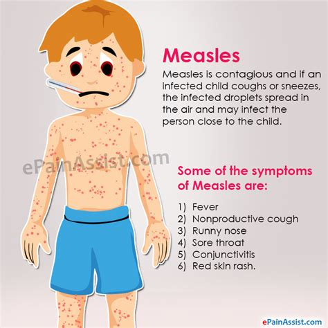 Measles Treatment Home And Natural Remedies Symptoms Causes