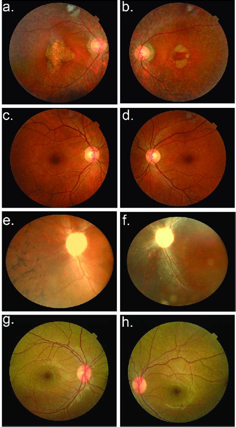 Fundus Photographs Of Individuals Examined For Retinitis Pigmentosa A
