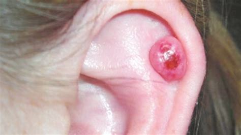 Suzannas Ear Cyst Should She Get It Removed Youtube